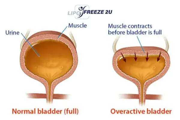 diagram of overactive bladder treatment Woodford