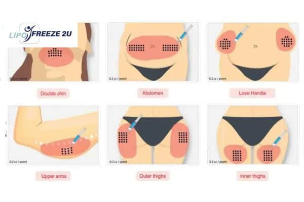 Benefits of Choosing Aqualyx for Fat Reduction Woodford
