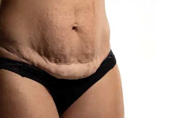 loose skin after weight loss injections Woodford