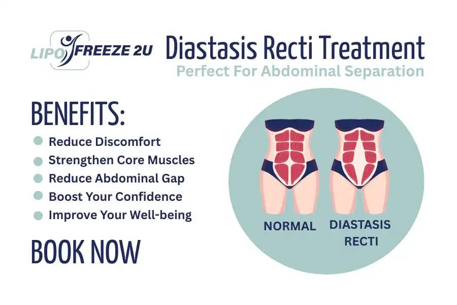 Benefits of body toning treatment Woodford for Diastasis recti