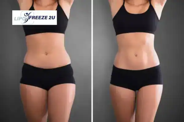 How Can LIPO FREEZE 2U Support Your Post-Pregnancy Body Recovery Woodford?