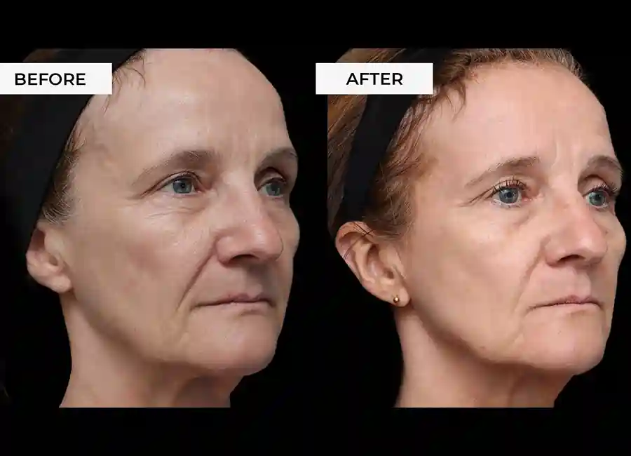 How Many RF Microneedling Sessions Will You Need to See a Difference Woodford?