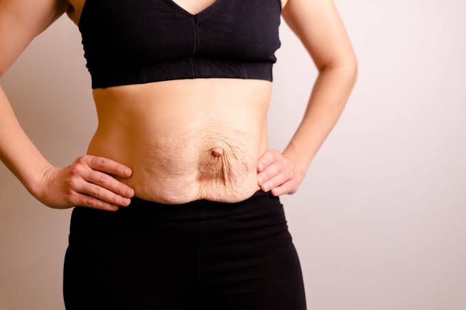 Is Surgery Really the Only Way to Repair Diastasis Recti Woodford?