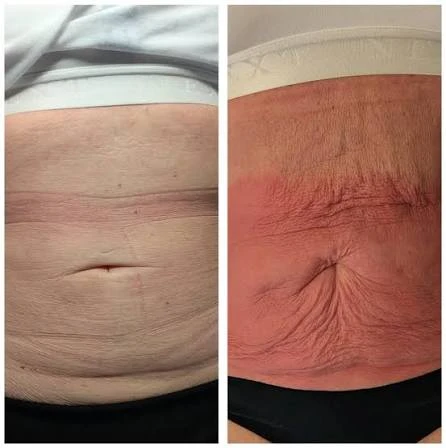 How Does RF Microneedling Improve Crepey, Thin and Uneven Skin Texture Woodford?