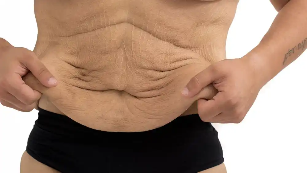 RF Microneedling for Loose Skin: How Can It Help Tighten and Reshape the Skin Woodford?